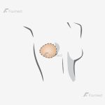 پروتز اکسترنال سینه آموئنا مدل essential 2E